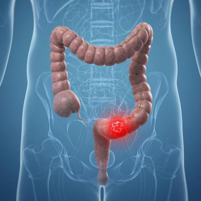 adenocarcinoma من القولون السيني