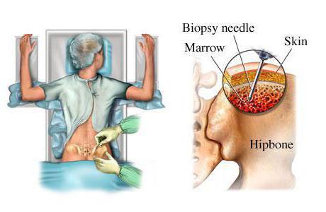 كيف هو trepanobiopsy من نخاع العظام؟ الغرض من هذا الإجراء