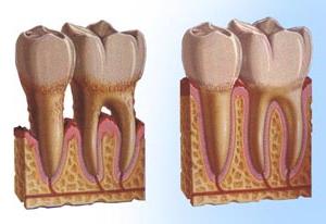 التهاب دواعم الأسنان: الأعراض والعلاجات