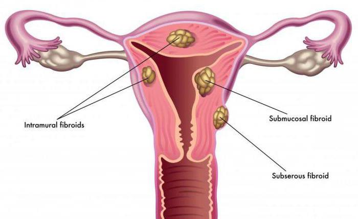 أسباب الرحم وعلاجه