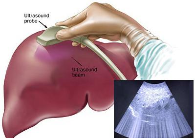 الموجات فوق الصوتية للكبد: التحضير للإجراء ، المؤشرات